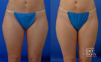 Hidden Liposuction  Before & After Gallery - Patient 141370 - Image 1