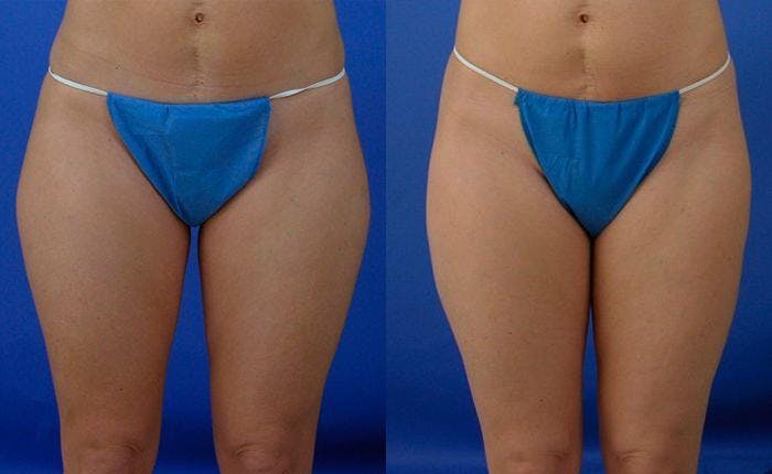 Liponique Body Contouring Before & After Gallery - Patient 122406076 - Image 1