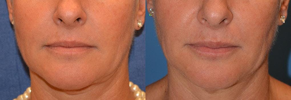 Lip Fillers Before & After Gallery - Patient 122406074 - Image 1