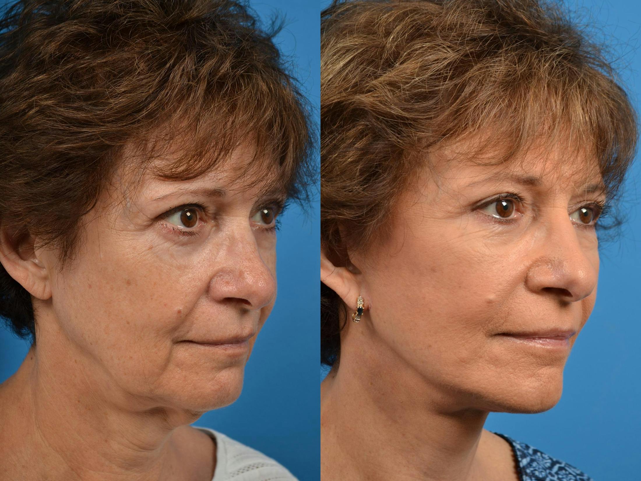 Facelift Before & After Gallery - Patient 122406078 - Image 4