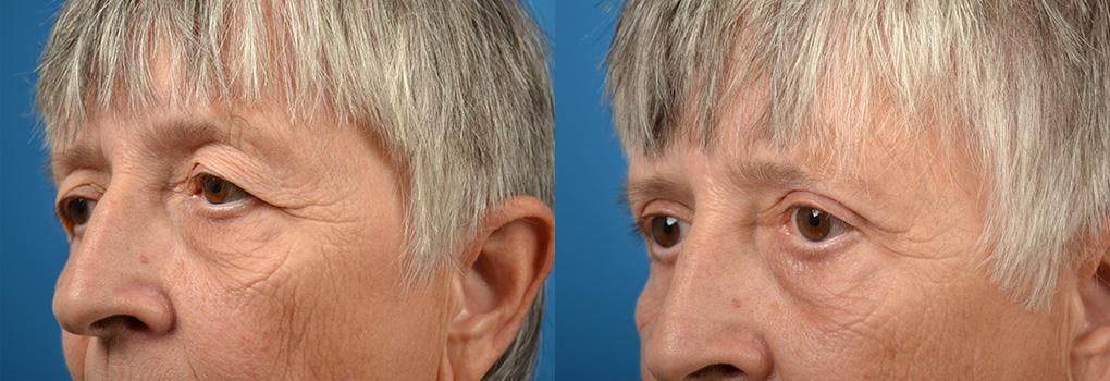 Eyelid Surgery Before & After Gallery - Patient 122406075 - Image 2