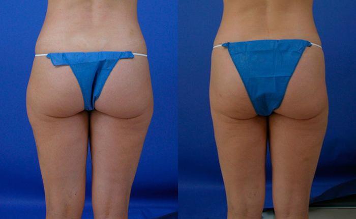 Hidden Liposuction  Before & After Gallery - Patient 141370 - Image 2