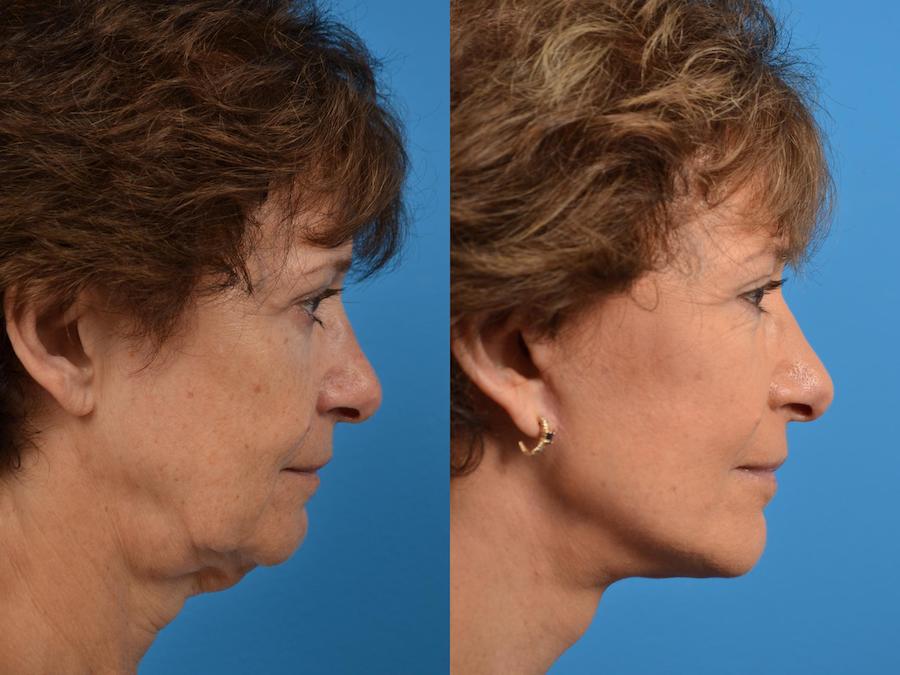Facelift Before & After Gallery - Patient 122406078 - Image 5