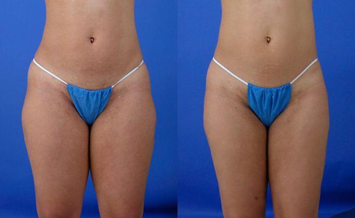 Liposuction Before & After Gallery - Patient 250988 - Image 1