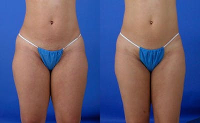 Liposuction Before & After Gallery - Patient 250988 - Image 1