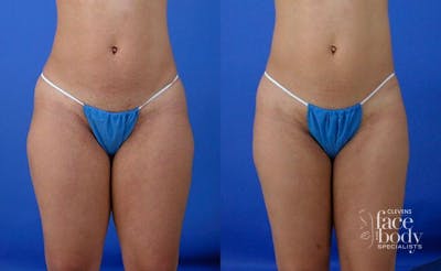 Hidden Liposuction  Before & After Gallery - Patient 392656 - Image 1