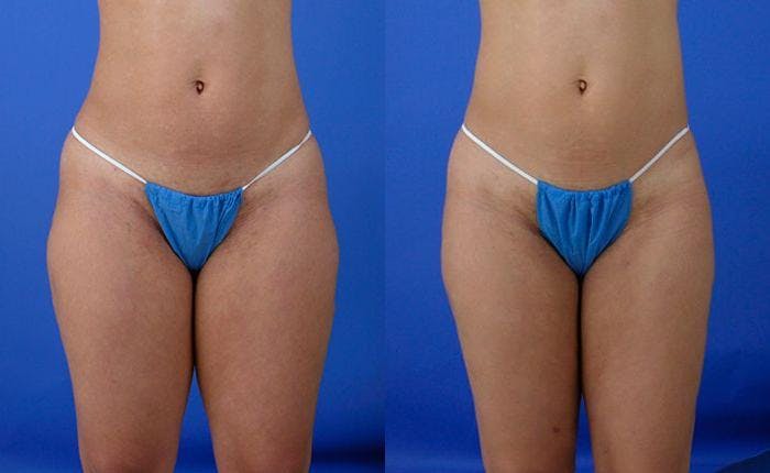 Liponique Body Contouring Before & After Gallery - Patient 122406079 - Image 1