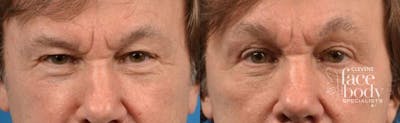 Eyelid Surgery Before & After Gallery - Patient 312617 - Image 1