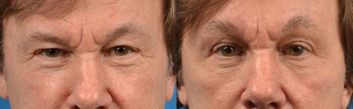 Eyelid Surgery Before & After Gallery - Patient 122406080 - Image 1
