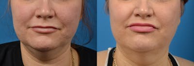 Lip Fillers Before & After Gallery - Patient 122406085 - Image 1