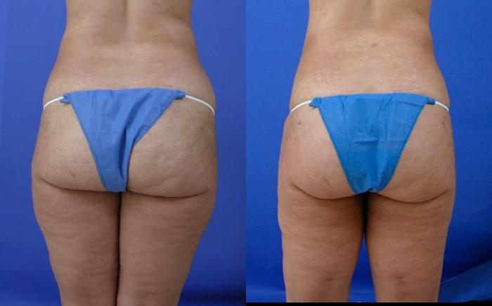 Hidden Liposuction  Before & After Gallery - Patient 392656 - Image 2