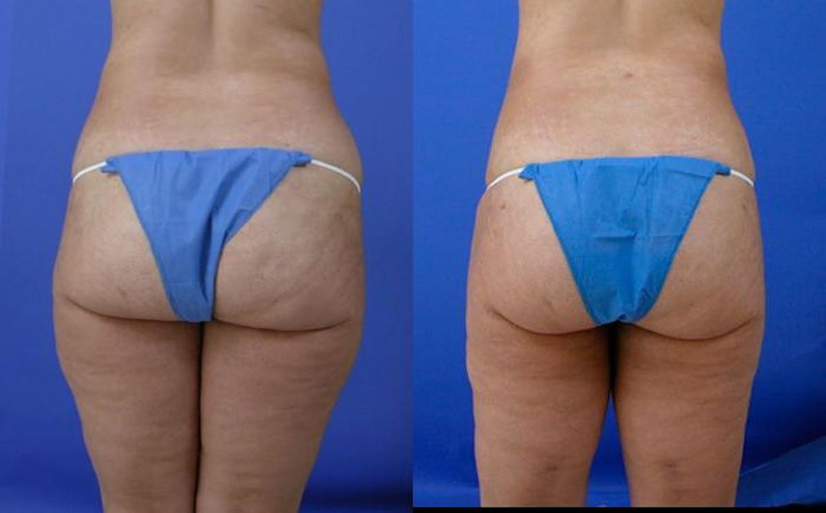 Liposuction Before & After Gallery - Patient 250988 - Image 2
