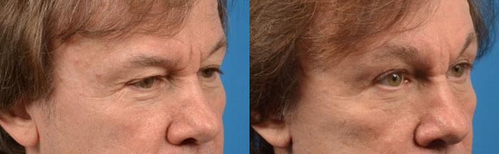 Eyelid Surgery Before & After Gallery - Patient 312617 - Image 2