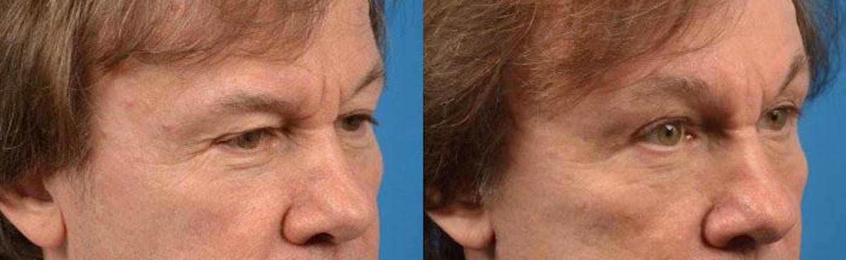 Eyelid Surgery Before & After Gallery - Patient 122406080 - Image 2