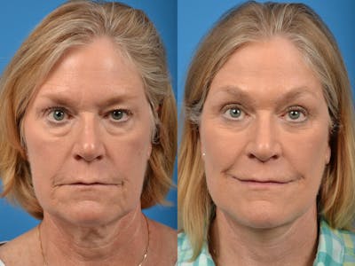 Facelift Before & After Gallery - Patient 122406089 - Image 1