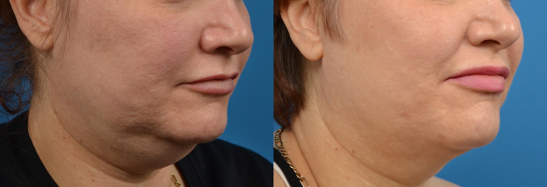 Lip Fillers Before & After Gallery - Patient 122406085 - Image 2