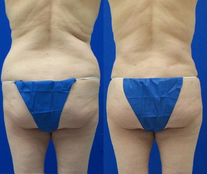 Hidden Liposuction  Before & After Gallery - Patient 166454 - Image 1