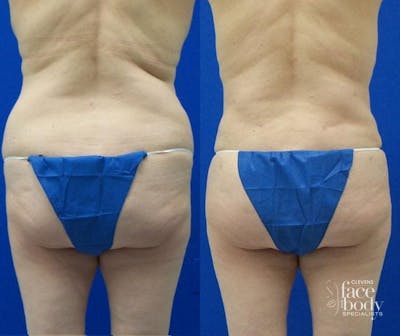 Hidden Liposuction  Before & After Gallery - Patient 166454 - Image 1