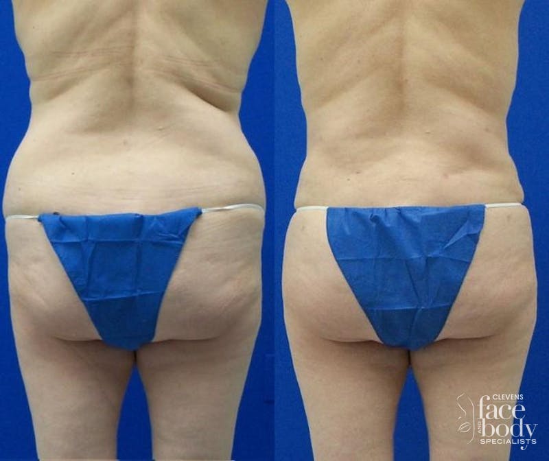 Hidden Liposuction Before & After Gallery - Patient 166454 - Image 1