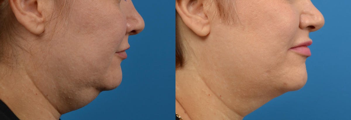 Lip Fillers Before & After Gallery - Patient 122406085 - Image 3