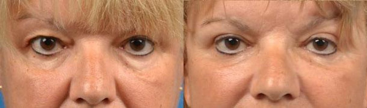 Eyelid Surgery Before & After Gallery - Patient 122406082 - Image 1