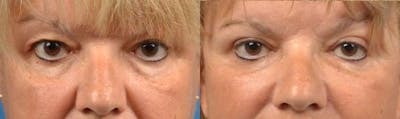 Eyelid Surgery Before & After Gallery - Patient 122406082 - Image 1