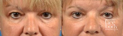 Eyelid Surgery Before & After Gallery - Patient 522738 - Image 1