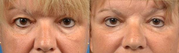 Eyelid Surgery Before & After Gallery - Patient 122406082 - Image 1