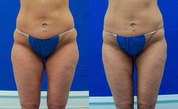 Hidden Liposuction  Before & After Gallery - Patient 111702 - Image 1