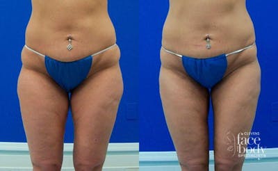Hidden Liposuction  Before & After Gallery - Patient 111702 - Image 1