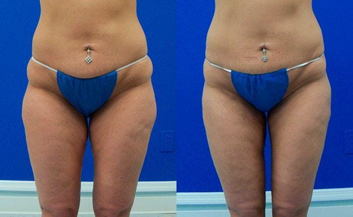 Liponique Body Contouring Before & After Gallery - Patient 122406083 - Image 1