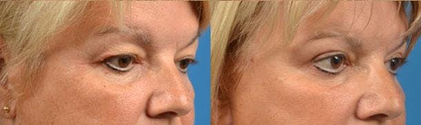 Eyelid Surgery Before & After Gallery - Patient 122406082 - Image 2