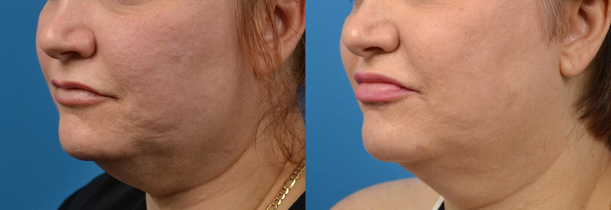 Lip Fillers Before & After Gallery - Patient 122406085 - Image 4