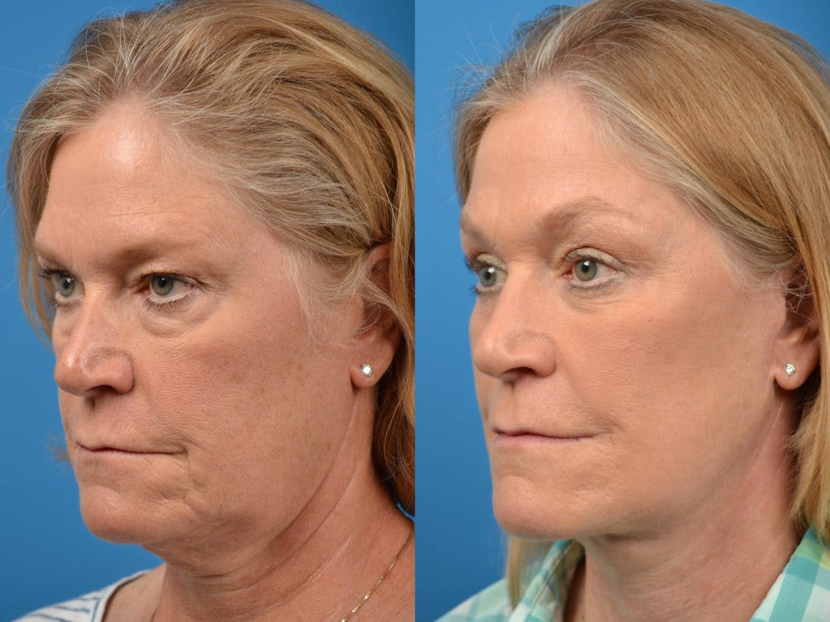 Facelift Before & After Gallery - Patient 122406089 - Image 3
