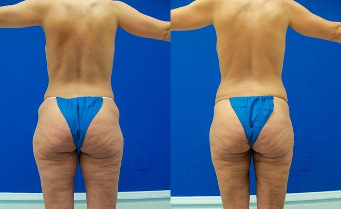 Hidden Liposuction  Before & After Gallery - Patient 111702 - Image 2