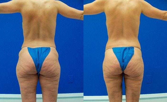 Liponique Body Contouring Before & After Gallery - Patient 122406083 - Image 2