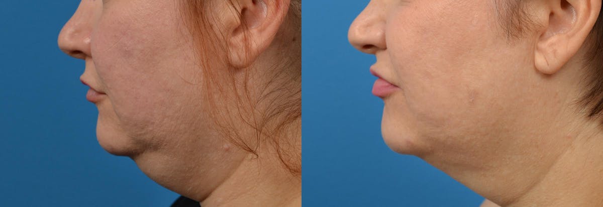Lip Fillers Before & After Gallery - Patient 122406085 - Image 5