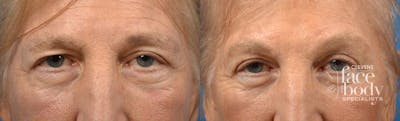 Eyelid Surgery Before & After Gallery - Patient 124679 - Image 1