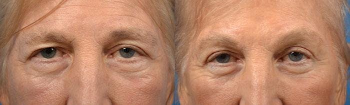 Eyelid Surgery Before & After Gallery - Patient 122406087 - Image 1