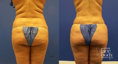Hidden Liposuction  Before & After Gallery - Patient 403659 - Image 1
