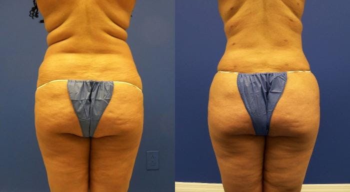 Liponique Body Contouring Before & After Gallery - Patient 122406084 - Image 1
