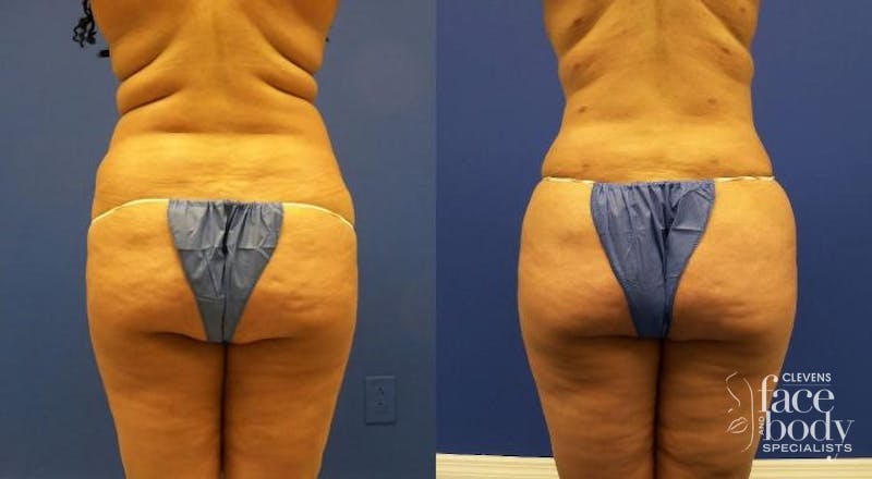 Hidden Liposuction Before & After Gallery - Patient 403659 - Image 1