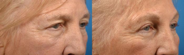 Eyelid Surgery Before & After Gallery - Patient 124679 - Image 2