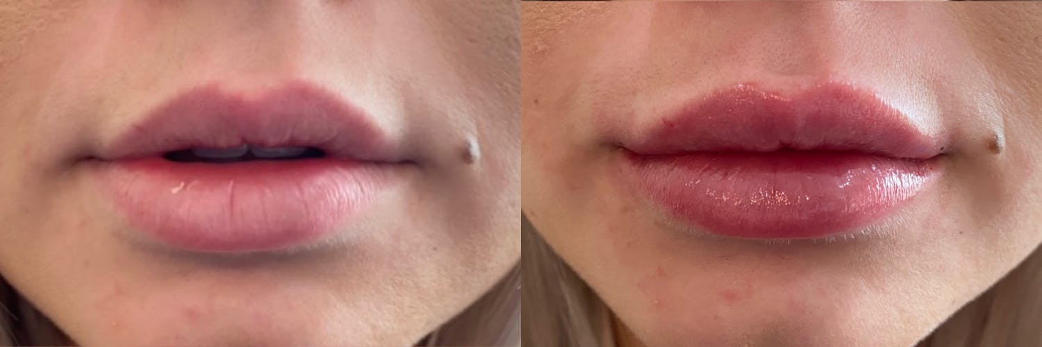 Lip Fillers Before & After Gallery - Patient 122406088 - Image 1