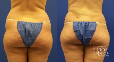 Hidden Liposuction  Before & After Gallery - Patient 415765 - Image 1
