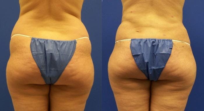 Liponique Body Contouring Before & After Gallery - Patient 122406086 - Image 1