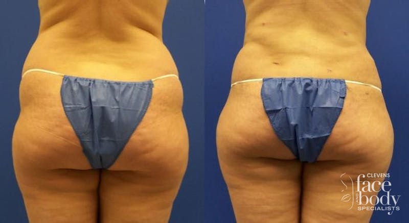Hidden Liposuction Before & After Gallery - Patient 415765 - Image 1