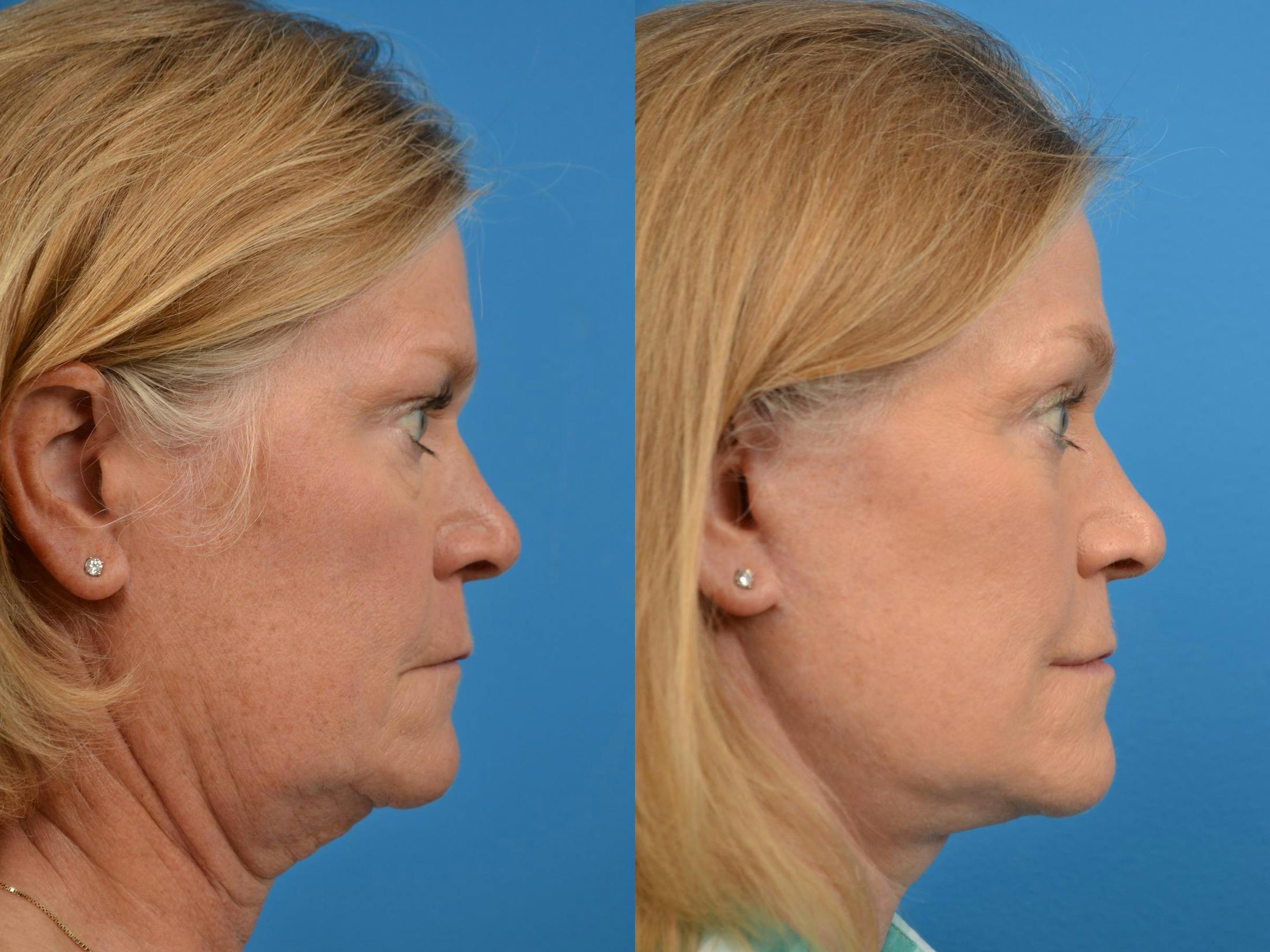 Facelift Before & After Gallery - Patient 122406089 - Image 5