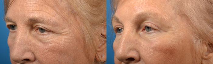 Eyelid Surgery Before & After Gallery - Patient 124679 - Image 3