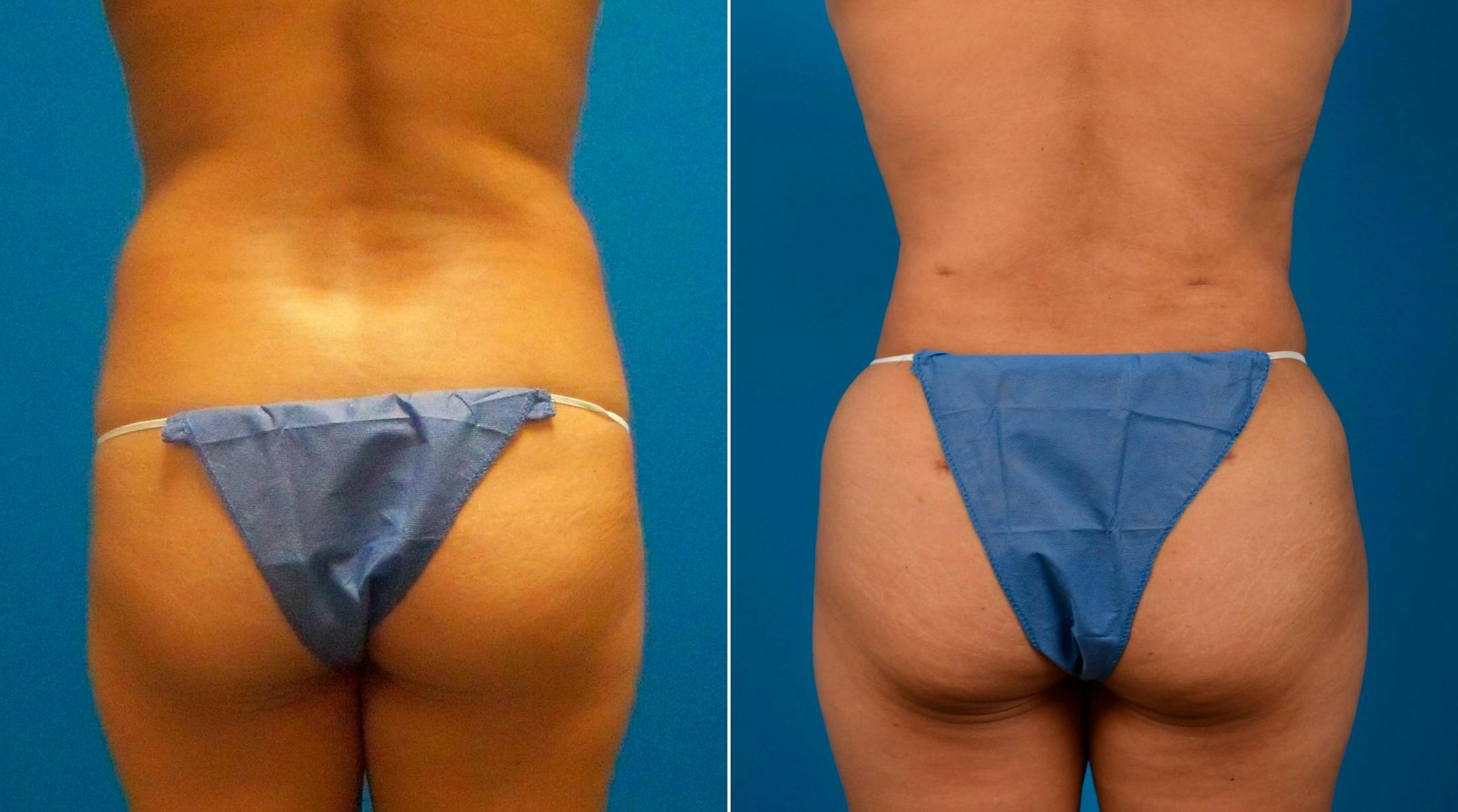 Liponique Body Contouring Before & After Gallery - Patient 122406090 - Image 1